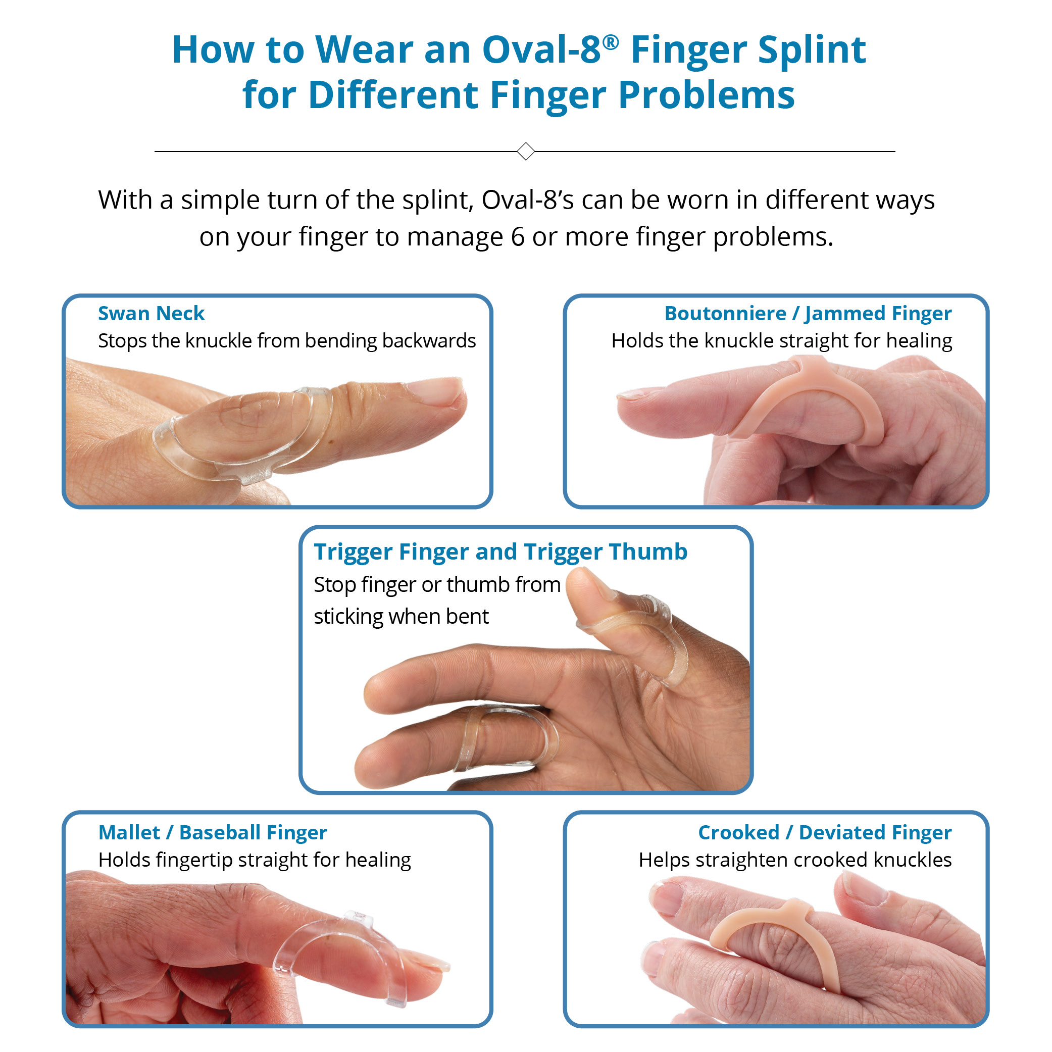 Sticky fingers: what to do about trigger finger and mallet finger - The  Portland Clinic
